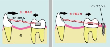 2020年 7月 歯科矯正用アンカースクリューを使用した矯正歯科治療